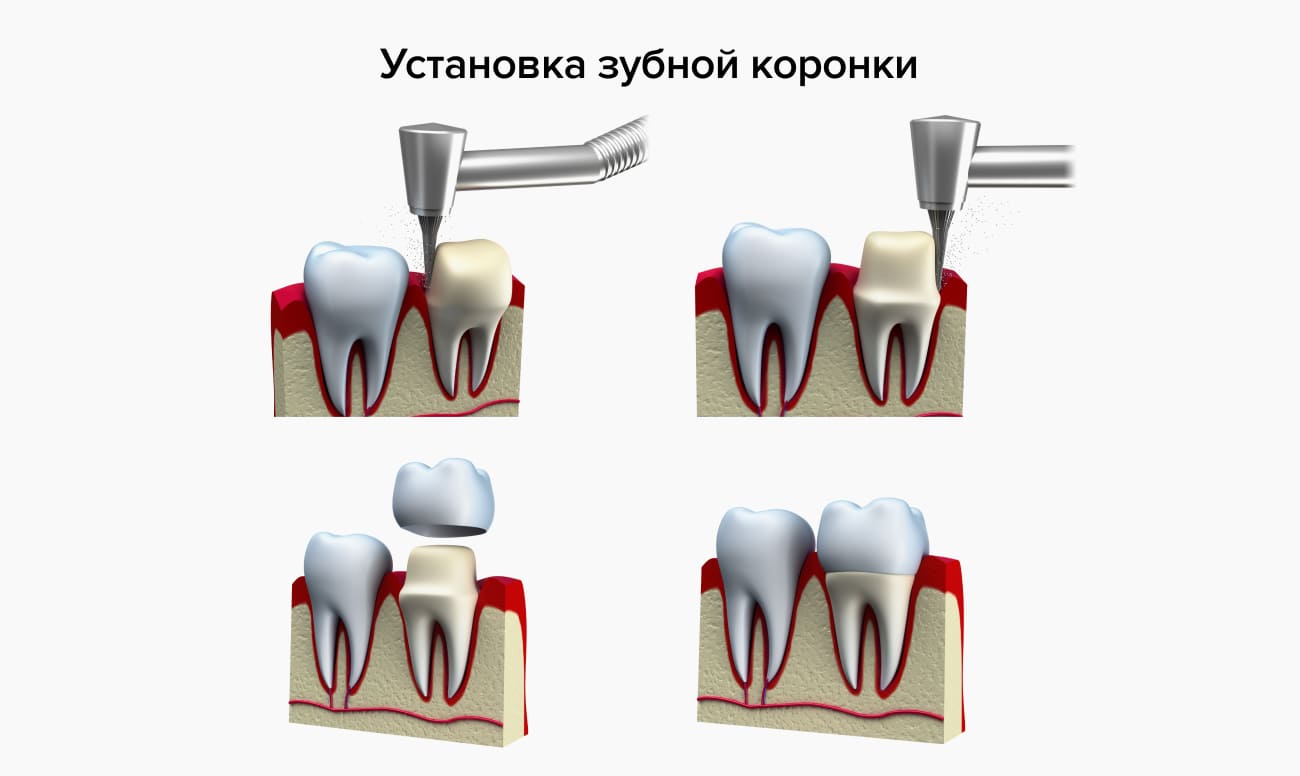 Установка зубной коронки в картинках