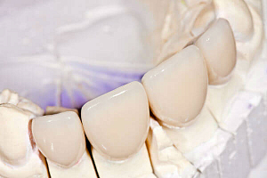 Какие зубные коронки лучше?